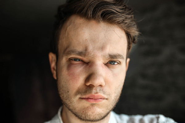 Photograph of angioedema showing swelling around the eyes and face