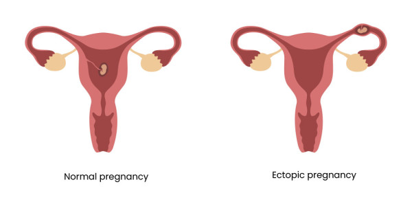 Medical illustration that shows a normal pregnancy where the egg is in the uterus, and an ectopic pregnancy where the egg is in the fallopian tube