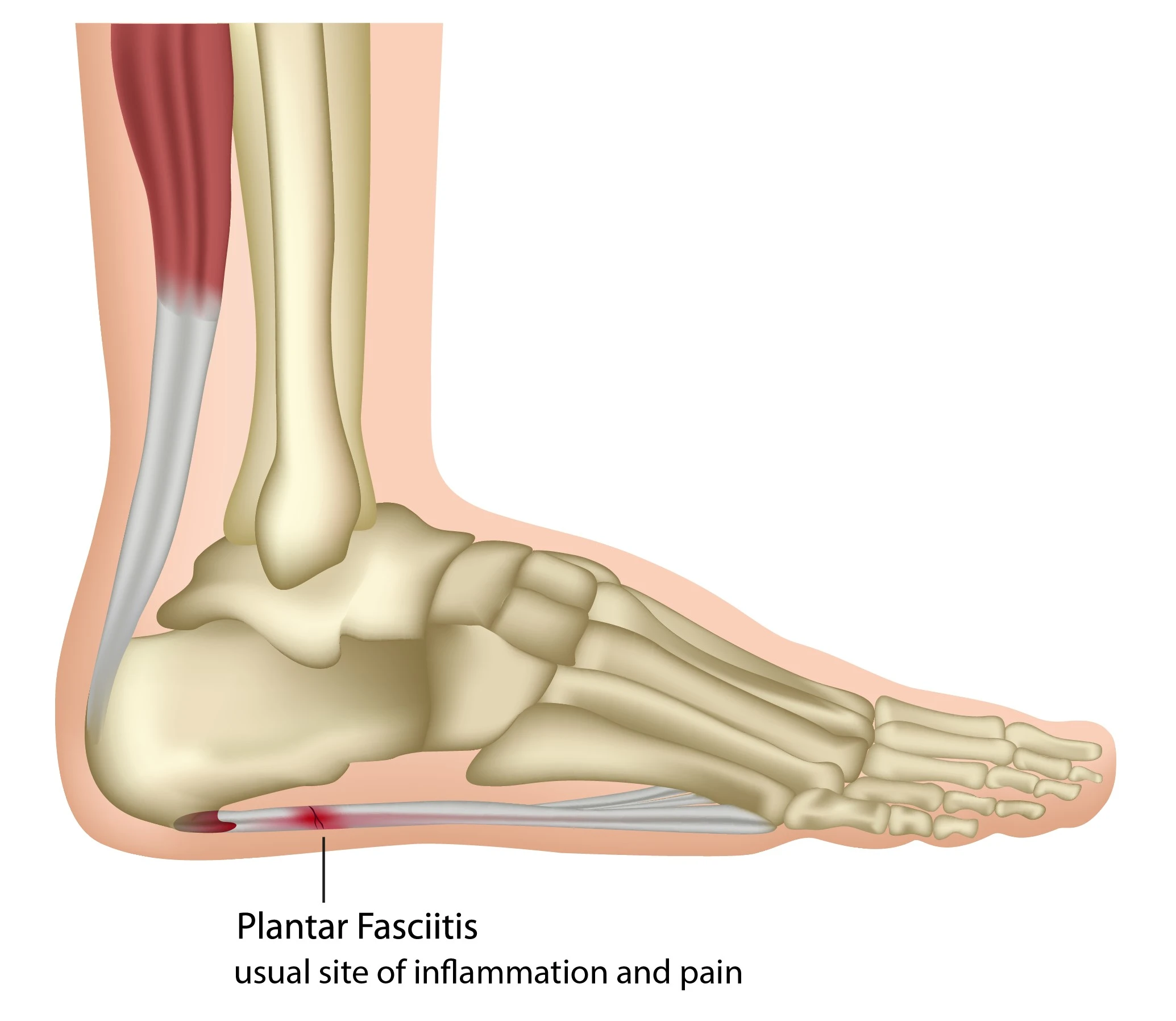 Plantar fasciitis — anatomic illustration of the ankle, foot and plantar fascia