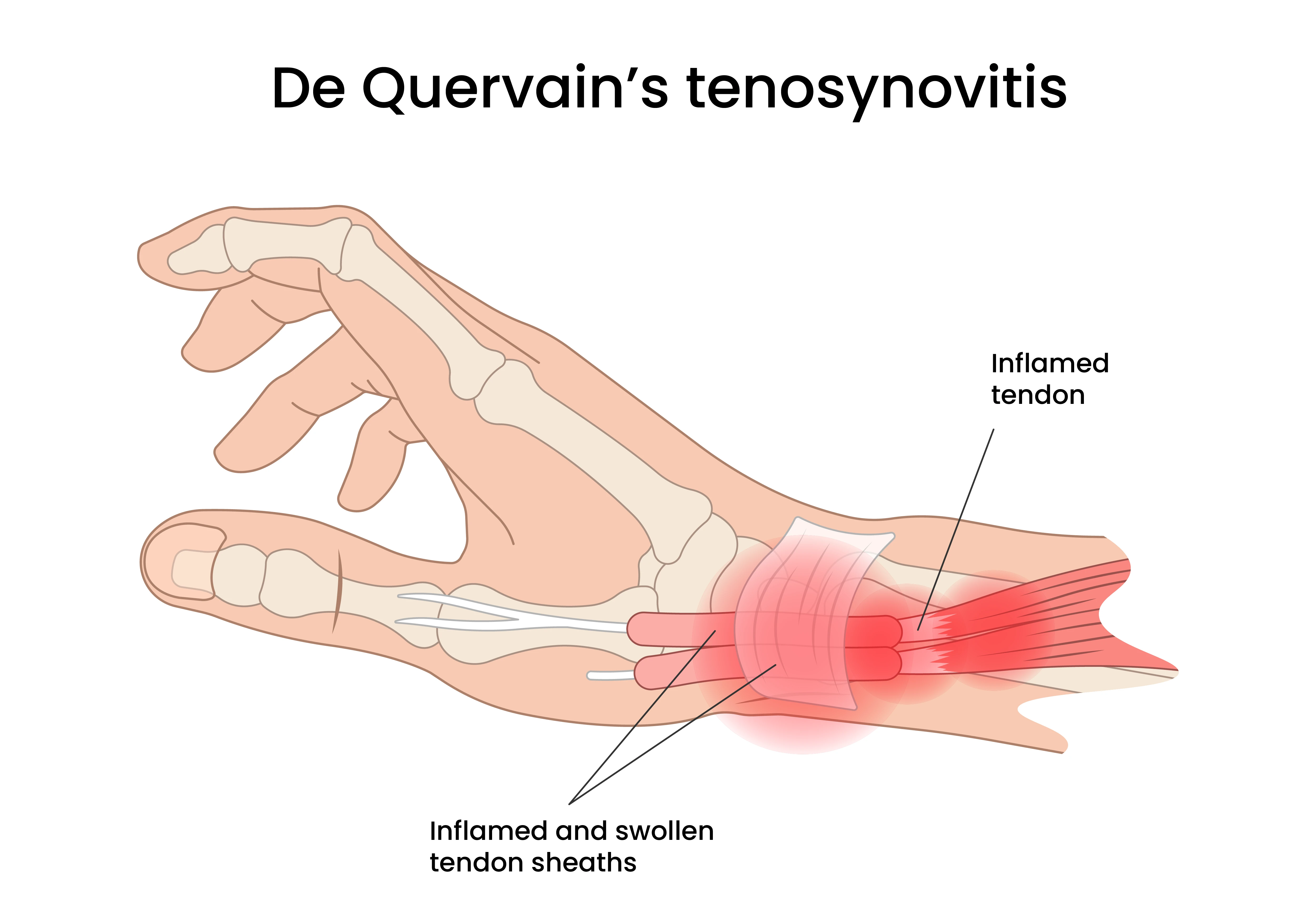 Anatomic illustration of de Quervain's tenosynovitis