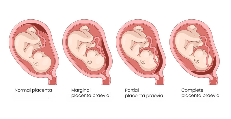 4 illustrations of a baby in the uterus showing the different positions a placenta can implant - ranging from high in the uterus to low and covering the cervix. 